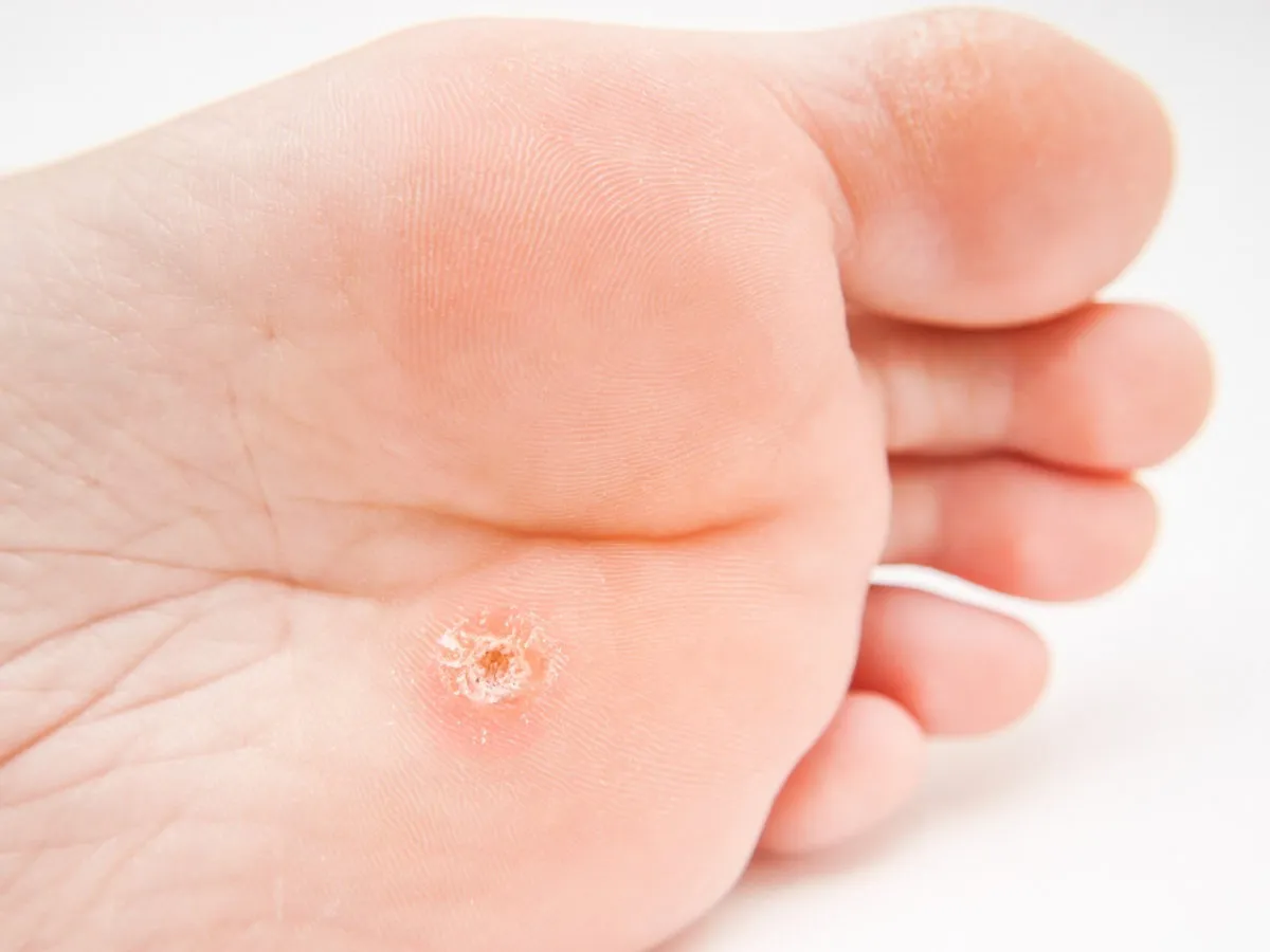 Verruga plantar